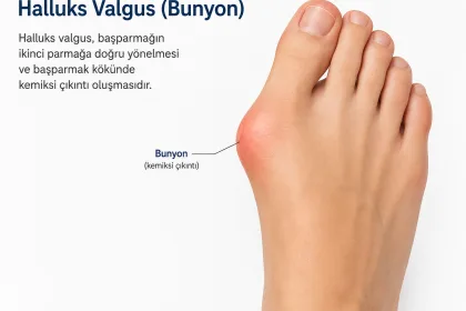 Ayak Başparmak Şekil Bozukluklarından Halluks Valgus Tanısı ve Tedavisi