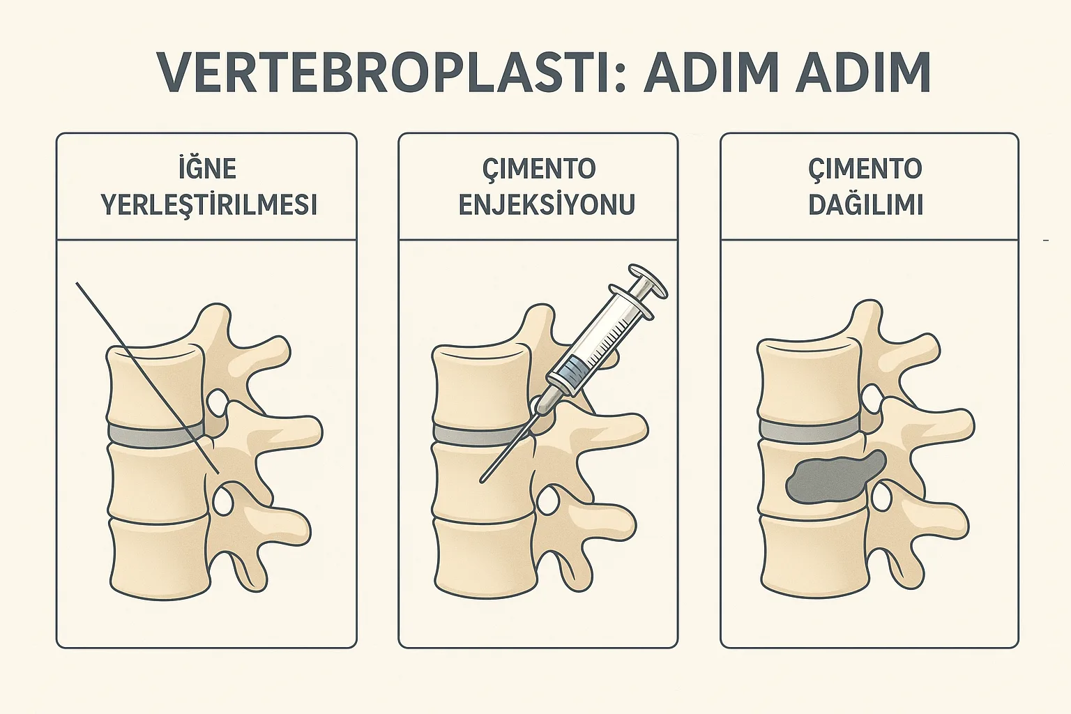 Vertebroplasti