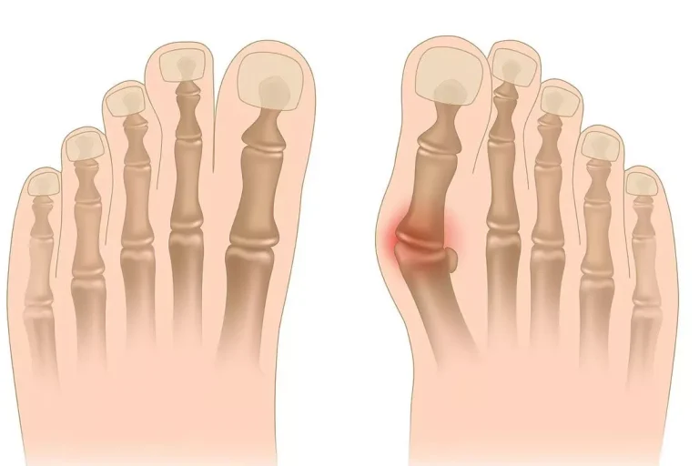 Halluks Valgus (Bunyon) Nedir ?