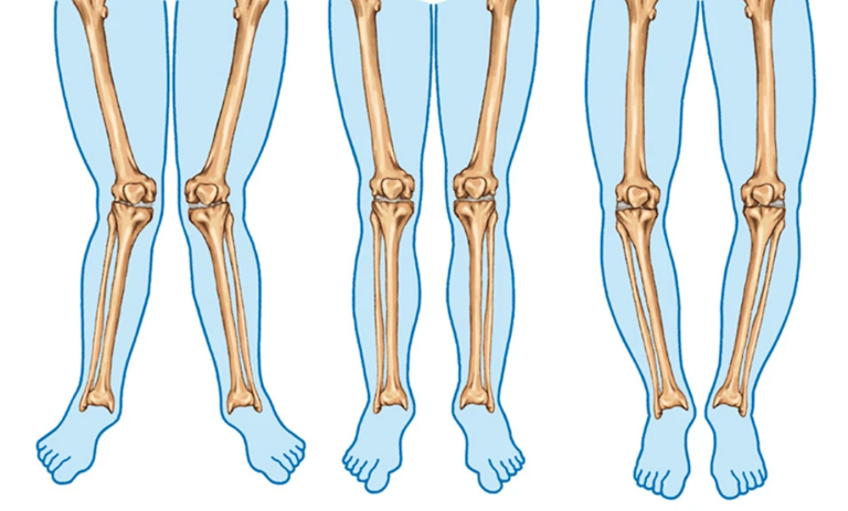 Kireçlenme (Osteoartrit) ile Başa Çıkma Yolları: İlaçlar, Fizik Tedavi ve Cerrahi