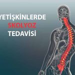 Skolyoz ve Skolyoz Ameliyatı Nedir?