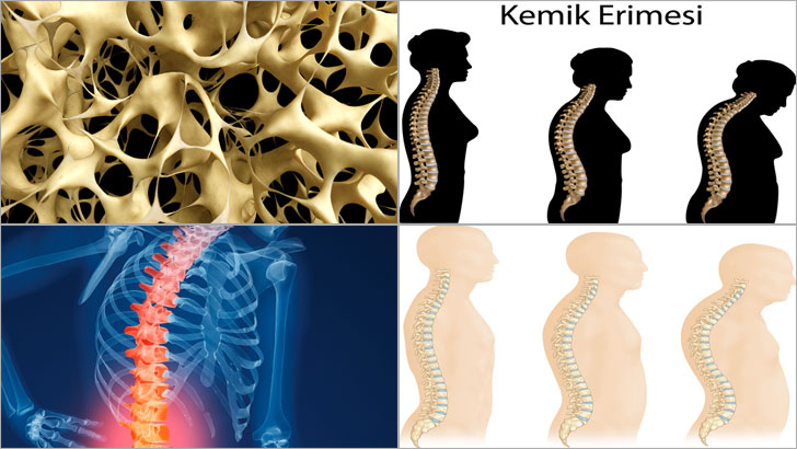 Omurga Osteoporozunda (Kemik Erimesi) İlaç Tedavisi PIN