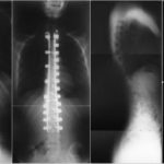 Belde Kanal Darlığında Cerrahi Olmayan Tedavi Yöntemleri