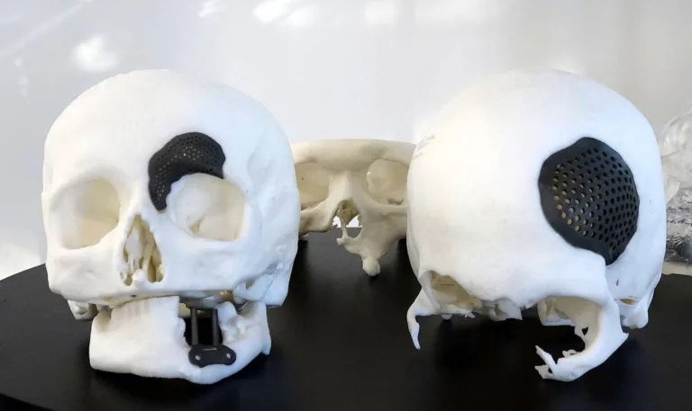 3D Yazıcı ile Kişiye Özel Kemik İmplantları: Geleceğin Ortopedisi