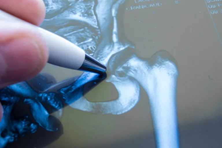 Yüksekten Düşme Vakası: Pelvis Kırığı ve Multidisipliner Tedavi