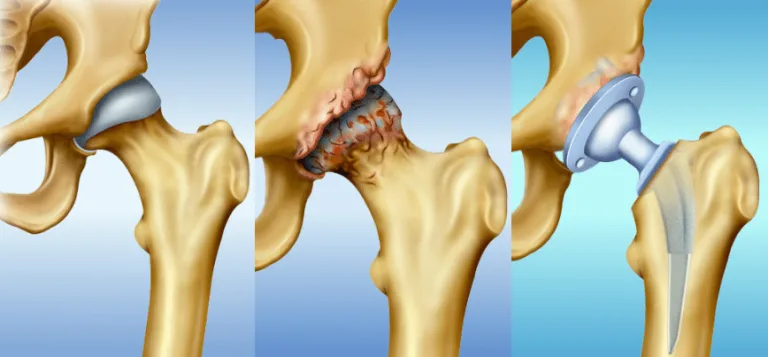 “Yaşlılarda Kalça Kırığı Sonrası İyileşme: Osteoporoz ile Mücadele İpuçları