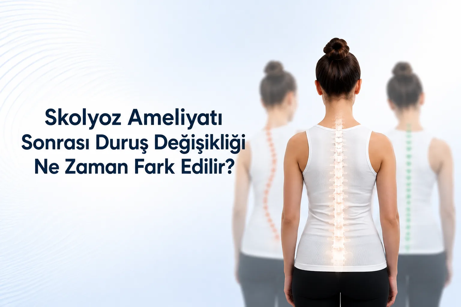 Skolyoz ameliyatı sonrası duruş değişikliği ne zaman fark edilir