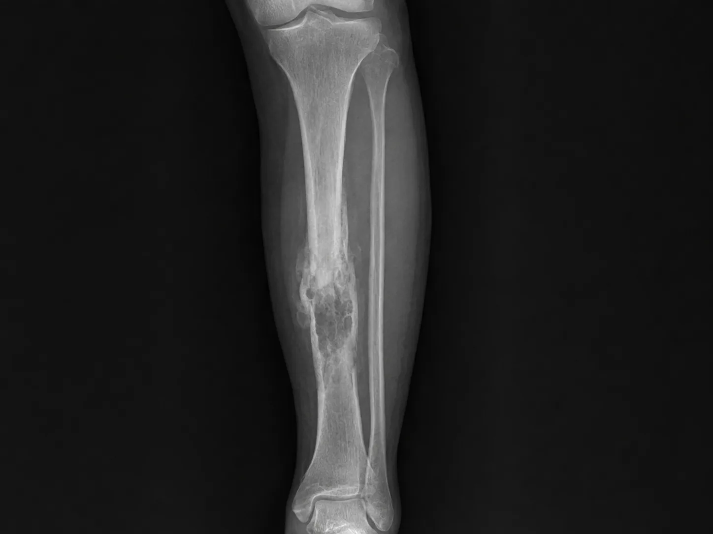 Osteomiyelit Nedir