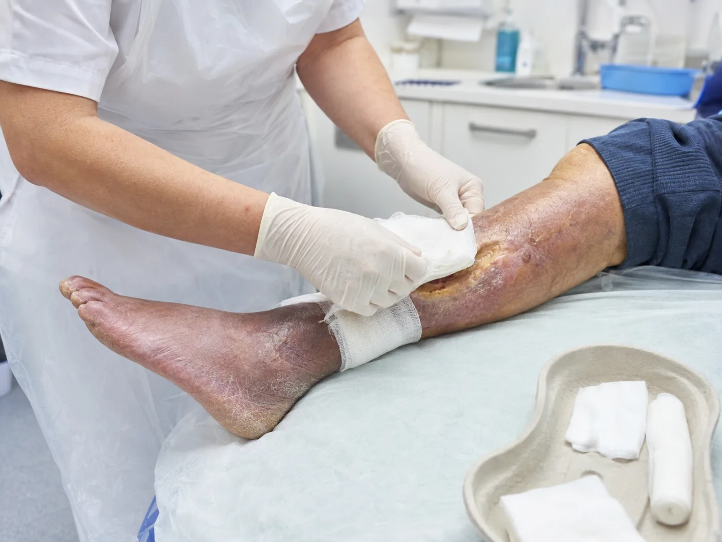 Osteomiyelit Nedir 